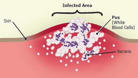 Graphic of infected tissue, skin, pus, bacteria, and infected area labeled