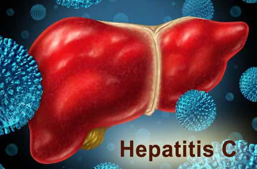 Hepatitis C